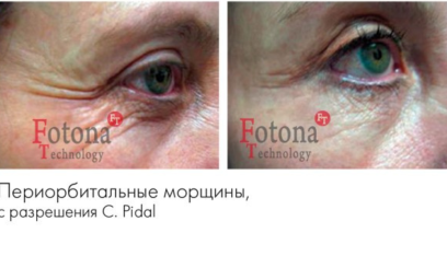 Фотона Глаза 9